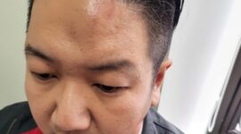 Pengusaha Semarang Agus Hartono mengalami lebam di wajahnya. (Dok. Istimewa)